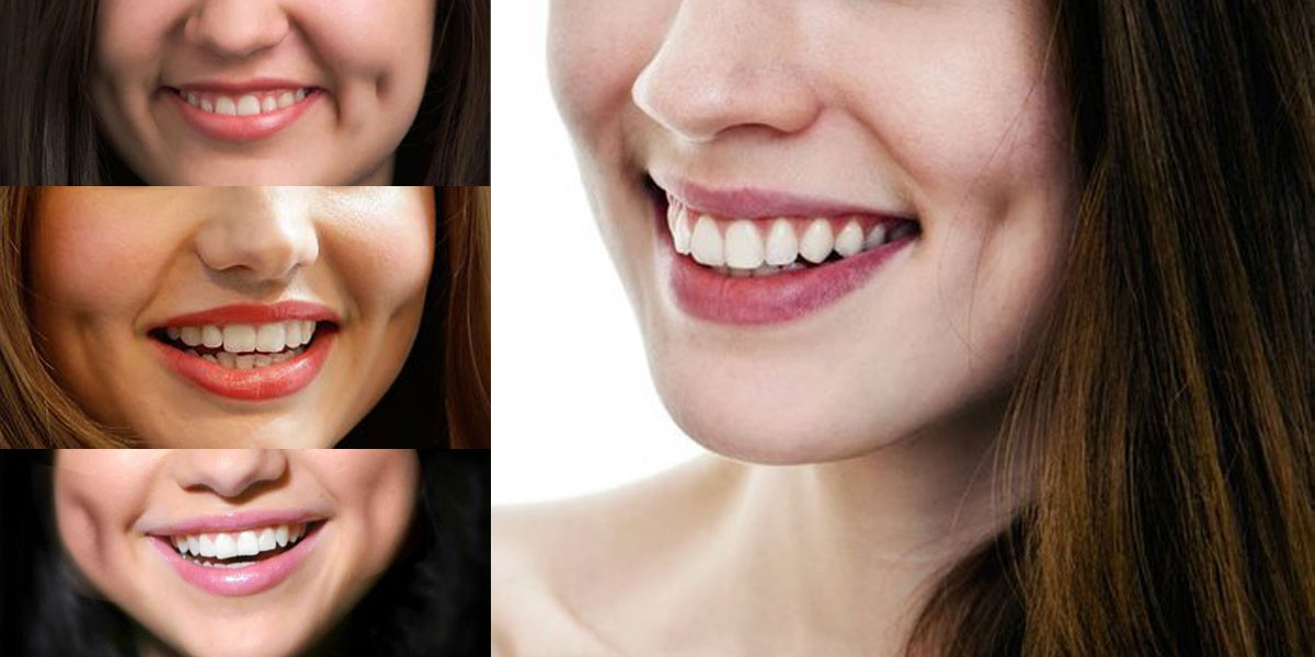 Dimples, a Symbol of Beauty or an Abnormality?